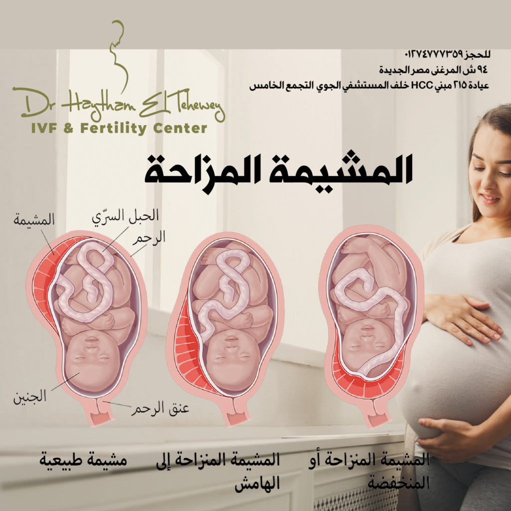 أنواع المشيمة المنزاحةTypes Of Placenta Previa