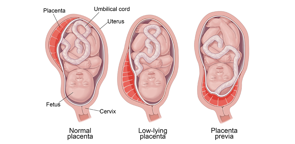 BC-PlacentaPrevia أنواع المشيمة المنزاحة