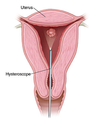 Hysteroscopy Laparoscopy & PRP