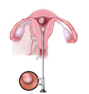 Hysteroscopy Laparoscopy & PRP